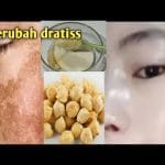 TIPS MERAWAT KULIT KEPALA DARI PERMASALAHAN KETOMBE YANG MEMBANDEL ALA MAHALINI